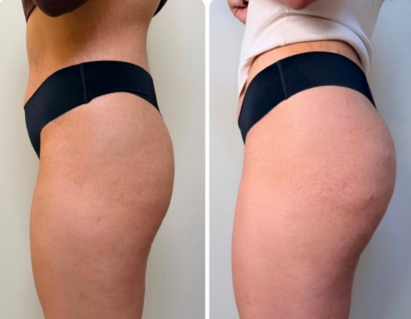 Resultado de harmonização de glúteos 4 — antes e depois